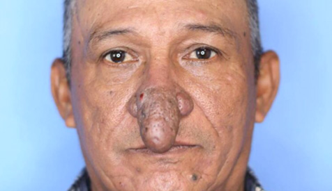 Un nez hors du commun sublimé par la chirurgie : découvrez le résultat spectaculaire