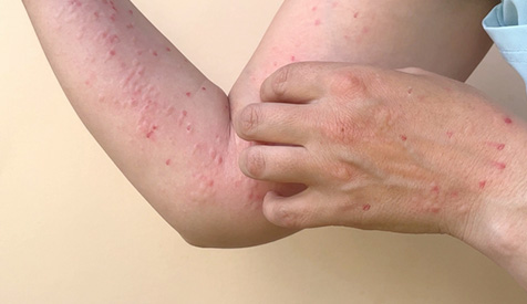 Tout savoir sur la variole du singe : une maladie à surveiller